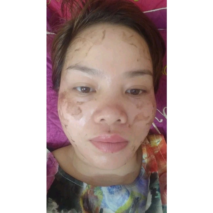 Bộ 3 Sản Phẩm HÚT NÁM, PHÂN HỦY NÁM dùng cho spa