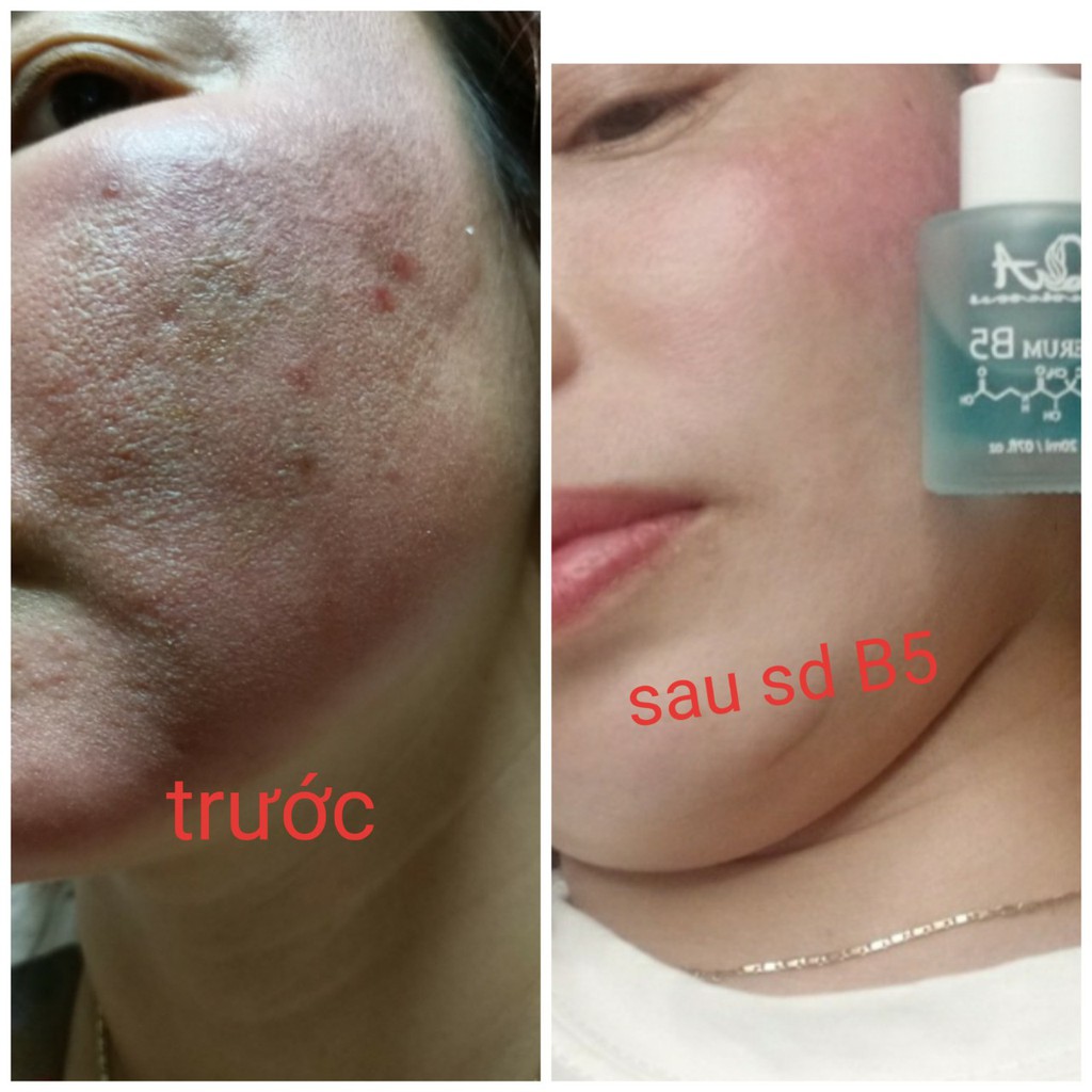 Serum B5 Cấp Ẩm Phục Hồi Làm Sáng Da QA Beauty spa