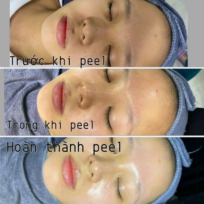Kem Peel Vitamin A 5% Innoaesthetics Tái tạo đều màu da giảm thâm mụn