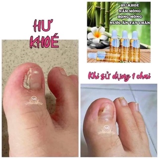 phục hồi móng hư tổn