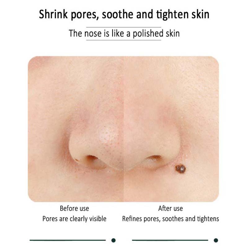 Miếng dán mũi RNW lột mụn đầu đen hai bước