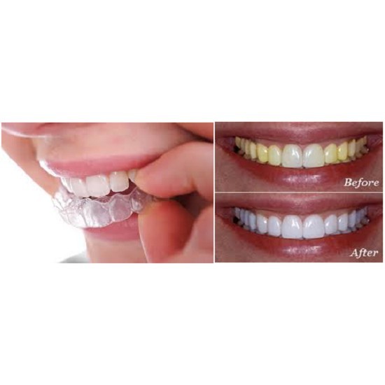 Thuốc Tẩy trắng răng tại nhà Opalescence 10% 15% 20% 35% chính hãng MỸ