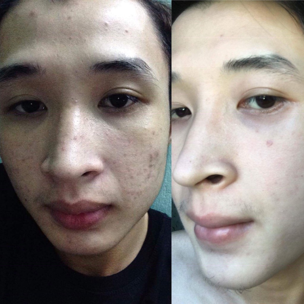 Cao lá nam trị mụn 💜 Chuyên sỉ SLL Cao lá nam trị mụn handmade | BigBuy360 - bigbuy360.vn