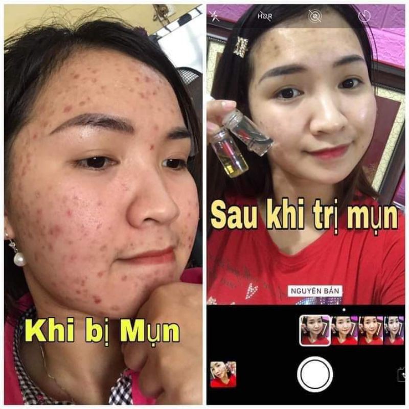 Đánh bay nốt mụn xấu xí cùng vua trị mụn Linh Hương (purity skin)