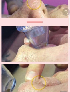 Máy hút mụn 3 đầu thay thế