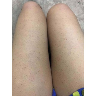 sỉ 5 viêm lỗ chân lông