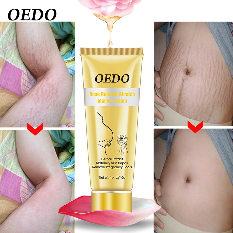 OEDO Rose Remove Stretch Marks Cream 40g | BigBuy360 - bigbuy360.vn