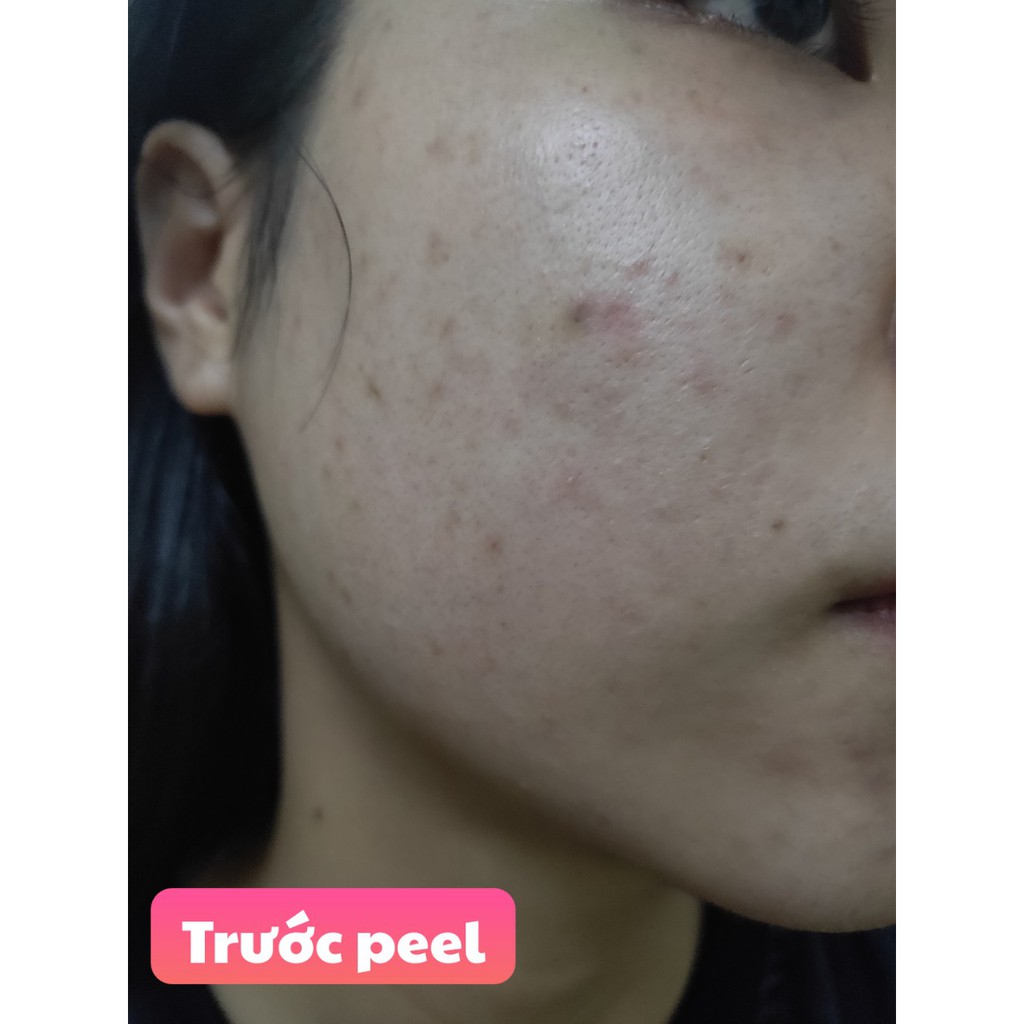 [Chính Hãng- Sẵn ] VI KIM TẢO BIỂN RESTING PEEL RONAS CHÍNH HÃNG 100%