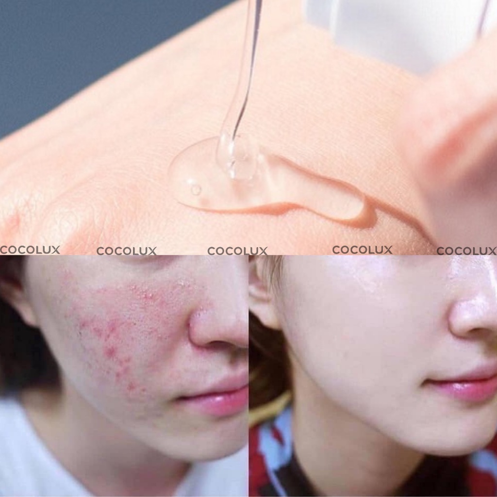 Gel Giảm Mụn Và Vết Thâm Gamma Megaduo Gel 15g [COCOLUX]