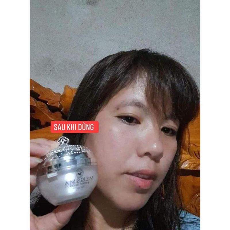 VUA NÁM MELASMA PERFECT CREAM TKH trần kim huyền
