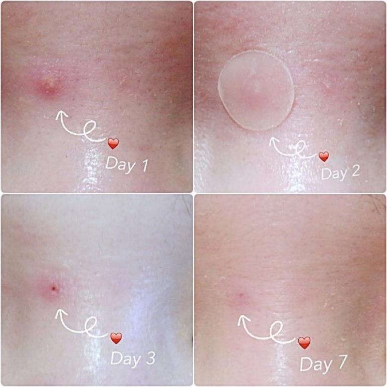 36 MIẾNG DÁN CHE MỤN, CHE KHUYẾT ĐIỂM THOÁNG KHÍ