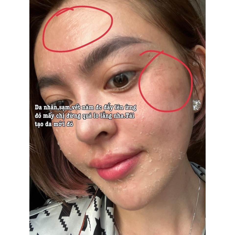 Peel Da Vi Tảo Retinol Trang Nemo -Skin peeling Trang Nemo