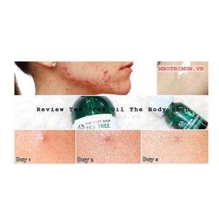 Tinh dầu chấm mụn Tea Tree oil