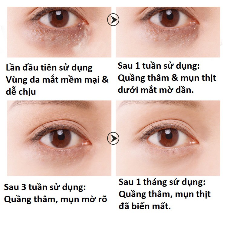 Kem Xóa Quầng Thâm, Tan Bọng Mắt, Giảm Mụn Thịt | BigBuy360 - bigbuy360.vn