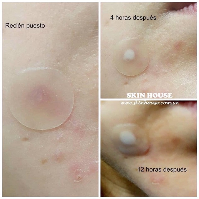 MIẾNG DÁN MỤN COSRX ACNE PIMPLE MASTER PATCH | BigBuy360 - bigbuy360.vn