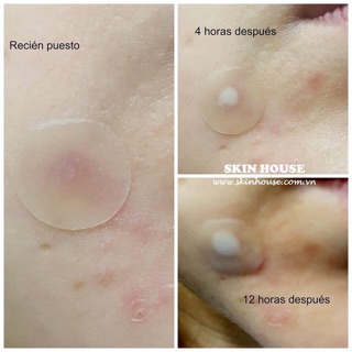 MIẾNG DÁN MỤN COSRX ACNE PIMPLE MASTER PATCH