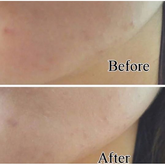 Kem Dưỡng Dạng Gel Làm Mờ Sẹo Mụn Và Thâm Mụn Hiruscar Post Acne Gel For Acne Scar And Dark Marks