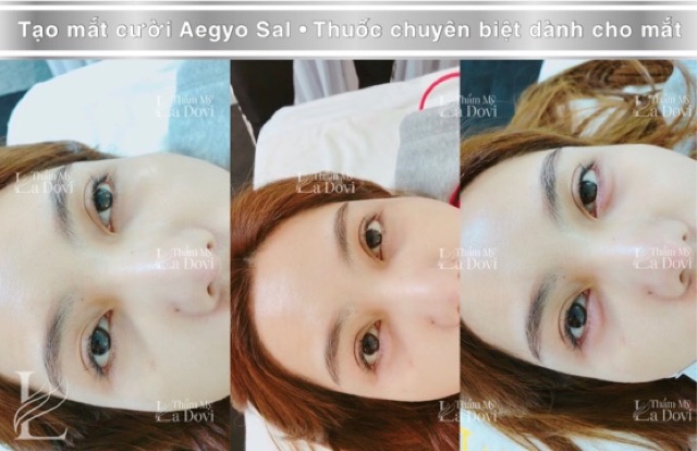 Tạo mắt cười Aegyo Sal đẹp long lanh như sao Hàn tại La Dovi Clinic 😍 Ngoài ra còn có xoá khử thâm quầng mắt nữa nhé •