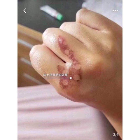 KEM MỜ SẸO GENTACIN SPA NHẬT BẢN - CỨU TINH MỌI LOẠI SẸO | BigBuy360 - bigbuy360.vn