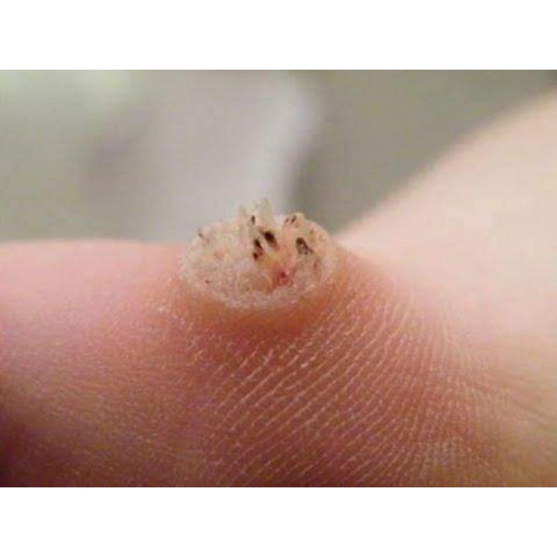 dung dịch diệt mụn cơm, mụn cóc, sạn cá | BigBuy360 - bigbuy360.vn