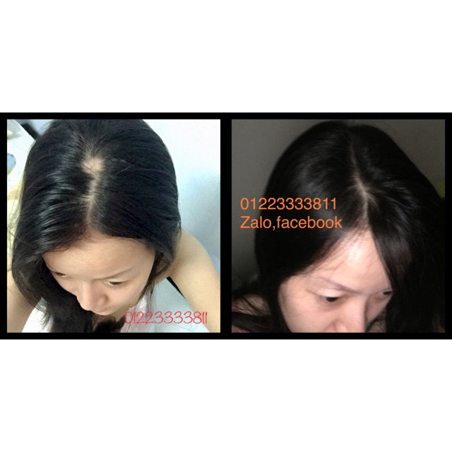 Thuốc mọc tóc, trị rụng tóc Yanagiya Hair Tonic