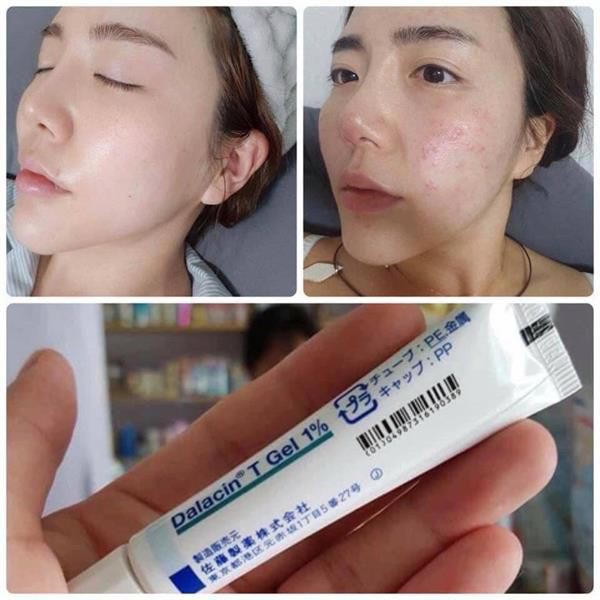 Kem mờ sẹo Gentacin Nhật Bản/KEM NGĂN NGỪA MỤN Dalacin | BigBuy360 - bigbuy360.vn