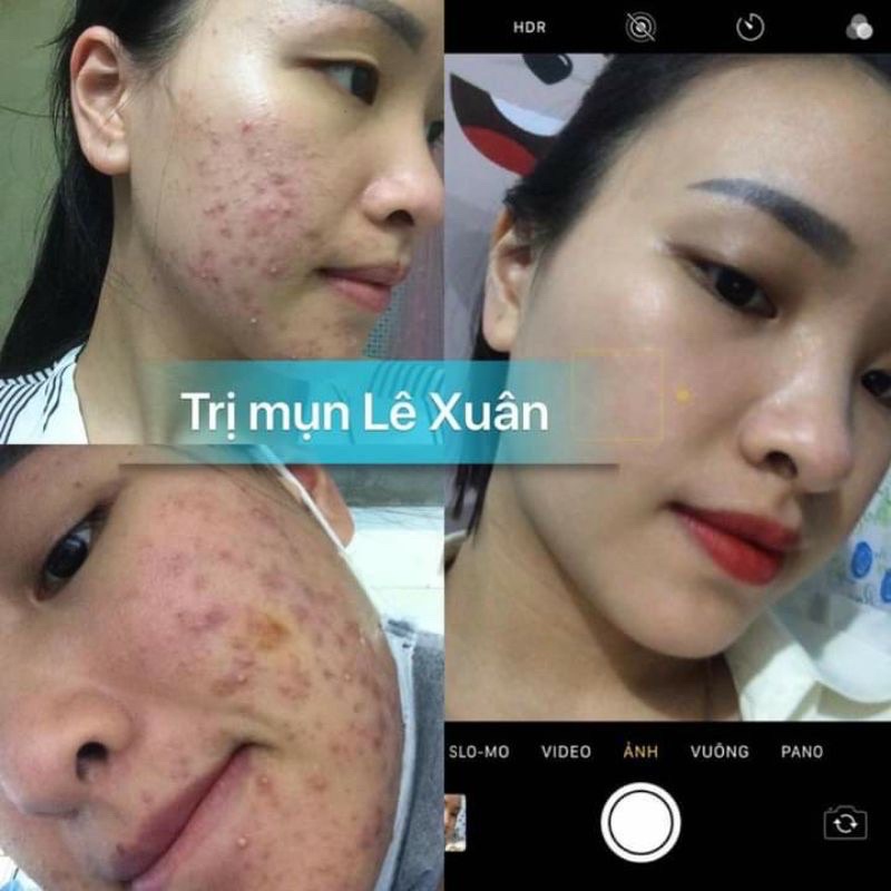 thảo dược đông y lê xuân💚 ngừa mụn lê xuân 💚 đánh bay mụn ẩn,mụn đầu đen,mụn bọc,mụn liti,mụn trứng cá... | BigBuy360 - bigbuy360.vn