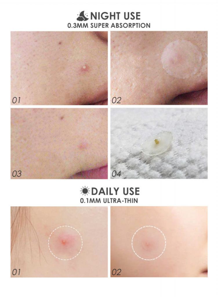 [Hàng mới về] Bộ 24 miếng dán diệt mụn ngày và đêm chứa tinh chất cây trà