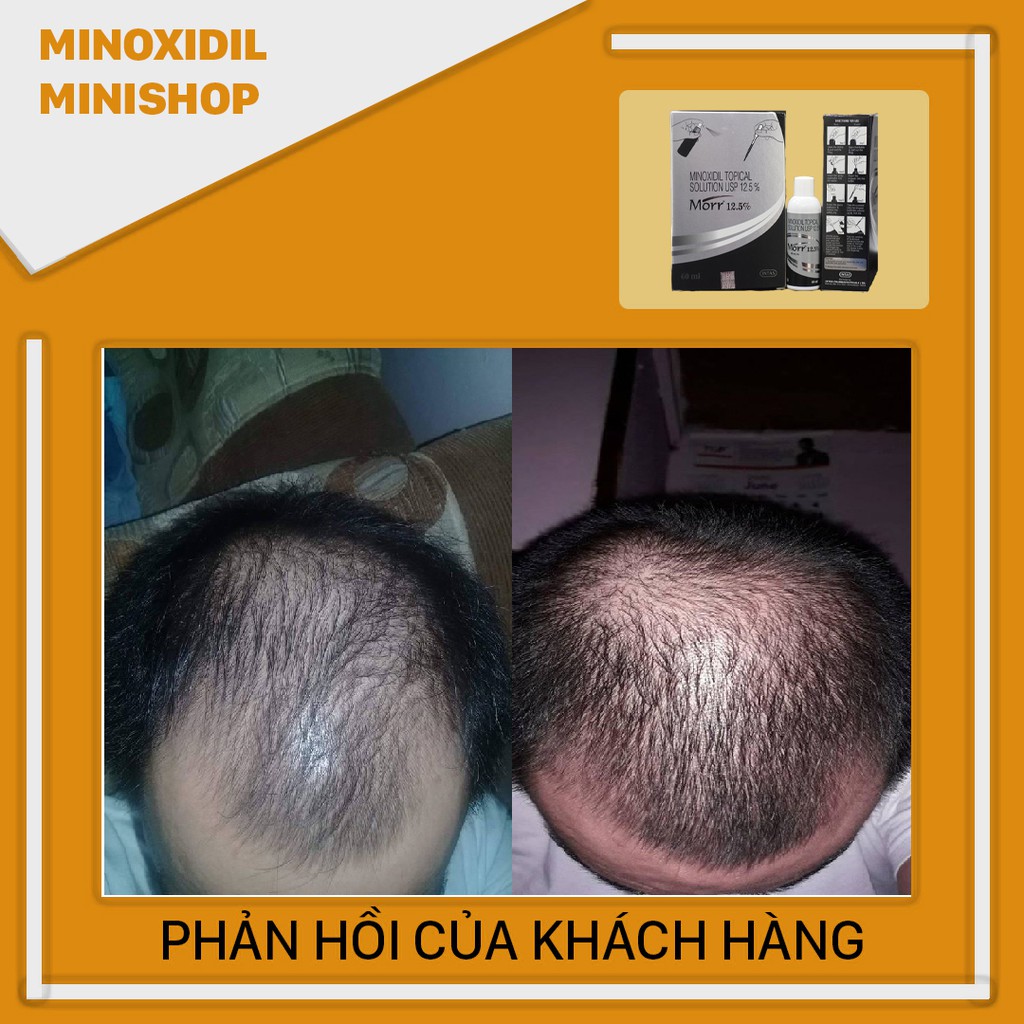 Minoxidil mọc râu tóc morr 12.5% lỏng