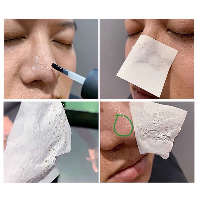 BLACKHEAD MASK (Lột mụn đầu đen)