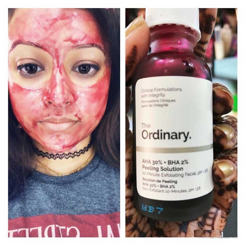 Tẩy Da Chết The Ordinary AHA 30% + BHA 2% Peeling Solution