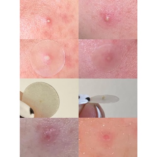 Miếng Dán Mụn Cosrx Acne Pimple Master Patch - Đỏ