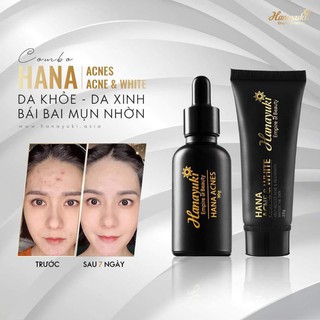 (CHÍNH HÃNG-Date 2026) BỘ 2 SP HANAYUKI GIẢM MỤN(SERUM MỤN VÀ KEM MỤN)