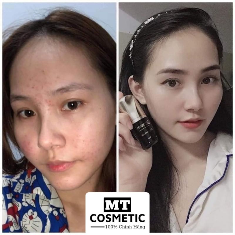SERUM Dermapeel+ TRỨNG CÁ TUYẾT - XÓA MỤN - Mờ THÂM MỤN - Se Khít LCL - DA CĂNG BÓNG - TRẮNG SÁNG SAU 14 NGÀY
