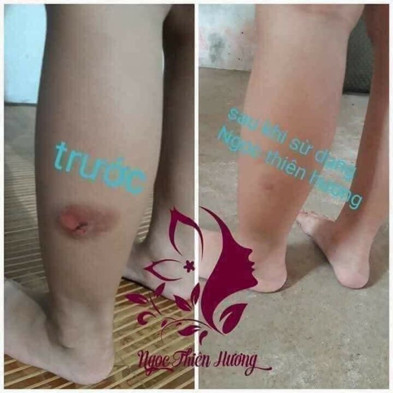 (Mua1tặng1)Tinh dầu Xóa thâm Ngọc Thiên Hương Xóa sạch thâm mụn, mắt, môi, nách, bikini, côn trùng đốt,...[ Chính Hãng ]