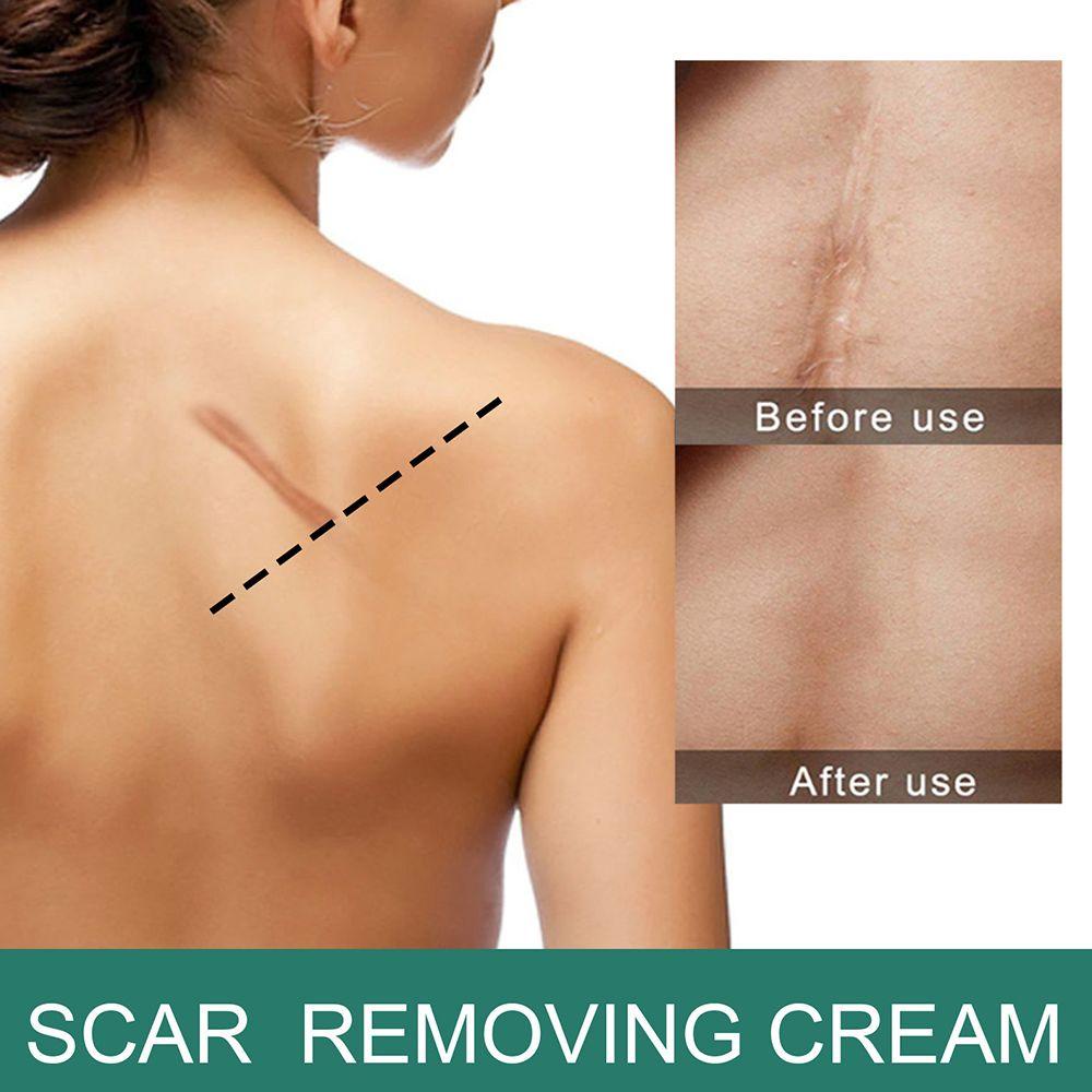 Kem Hỗ trợ giảm sẹo XIANTIN Chất Lượng Cao Tiện Dụng