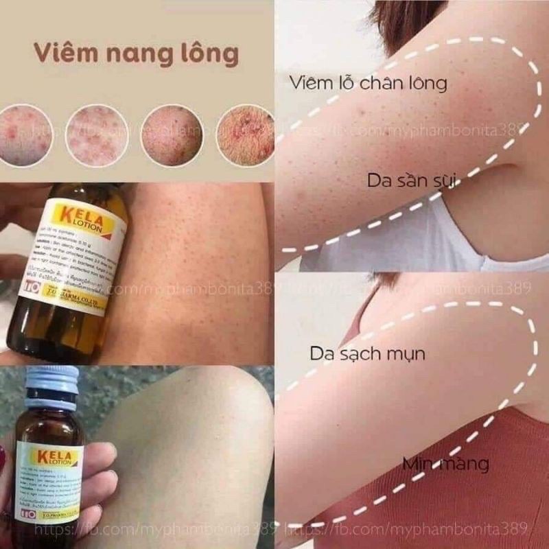 🌱 Kela Lotion Viêm Nang Lông Thái Lan 🇹🇭