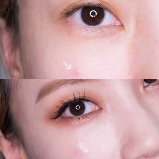 Miếng dán mụn Skinmate