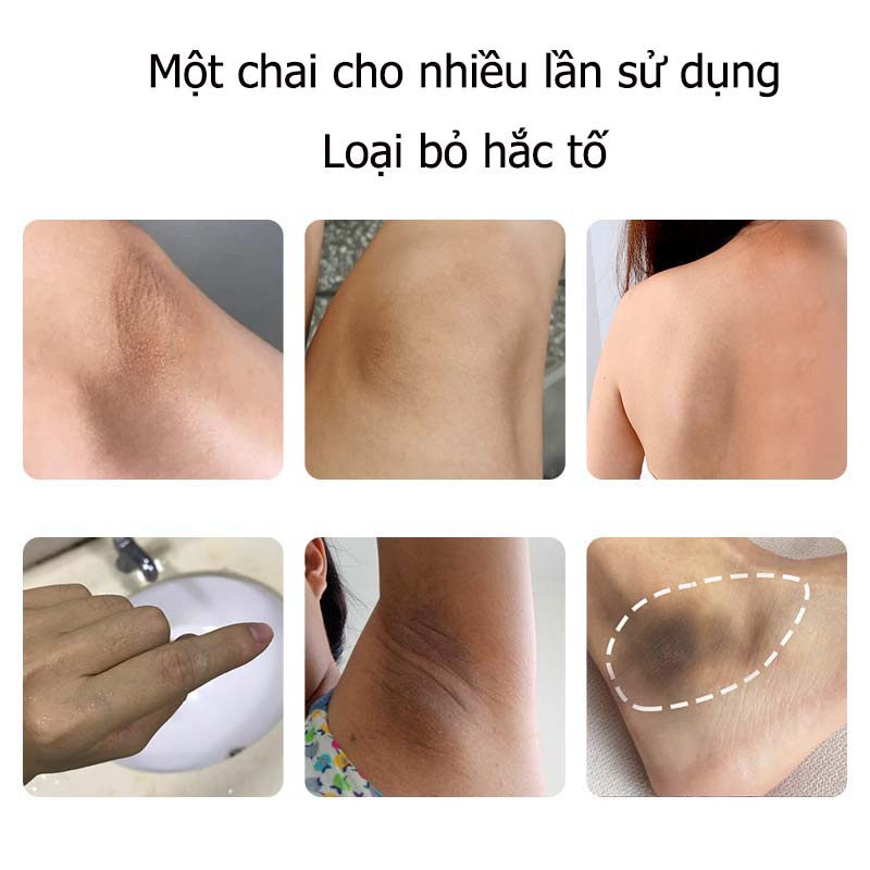 NAKIZ LIVELY BUTT kem thoa thâm & mụn vùng MÔNG/ BẸN/NHỦ HOA/ LƯNG/ NÁCH/ CÙI CHỎ/ ĐẦU GỐI