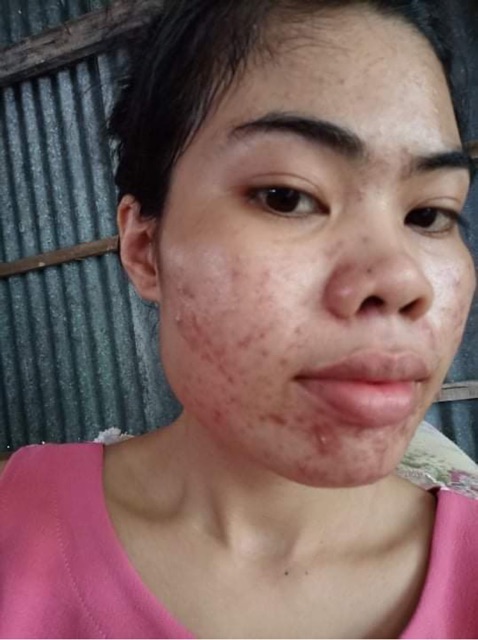 SERUM THANH DƯỢC - LÁRE( MẪU MỚI ) ĐIỀU TRỊ DA TỪ THIÊN NHIÊN | BigBuy360 - bigbuy360.vn