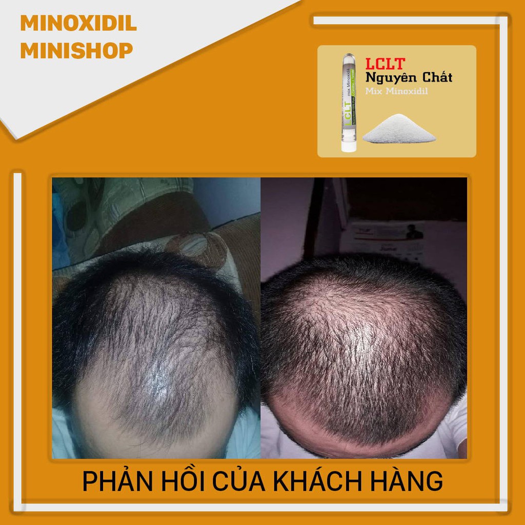 LCLT Hỗ Trợ Kích Thích Mọc Râu Tóc