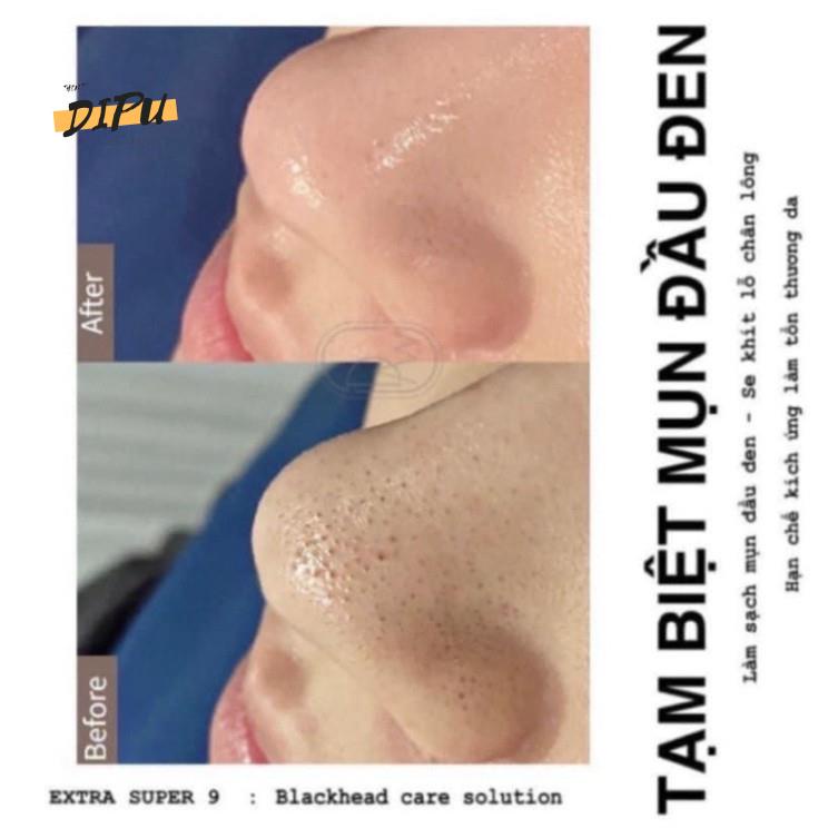 Ủ Mụn Medi-Peel Extra Super9- 50-100ml Mụn Cám Mụn Đầu Đen, Mụn Cám | BigBuy360 - bigbuy360.vn