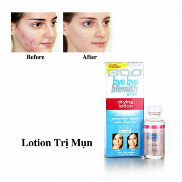 Chấm mụn Bye Bye Blemish Drying Lotion