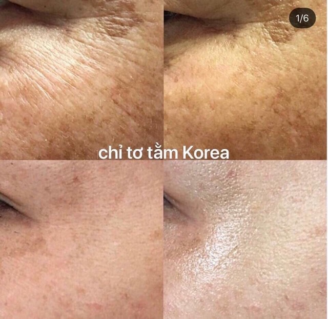 Serum chỉ tơ tằm Chitossil Non-Surgical Facial Lifting Thread Ampoule