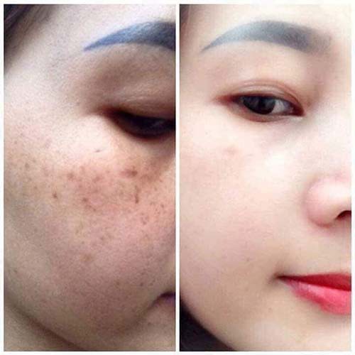Serum Mụn Chính Hãng Rulya Anti Acne