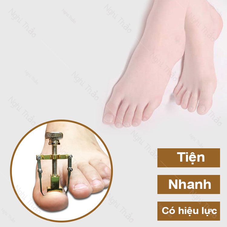 Dụng cụ điều chỉnh cố định móng mọc ngược