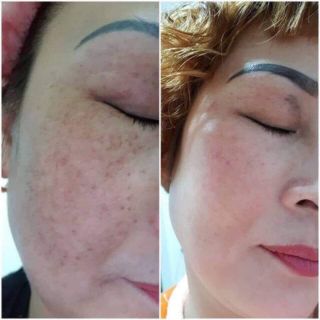 KEM NÁM DONGSUNG MẪU MỚI