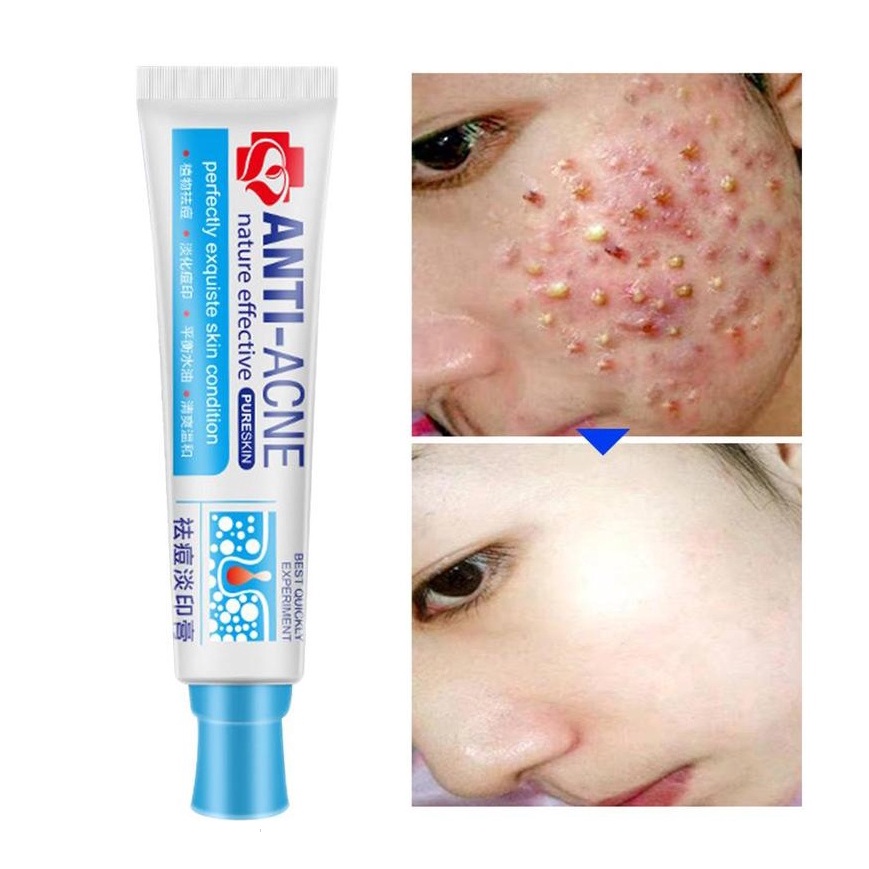 Kem thảo dược Trung Hoa trị mụn đầu đen và sẹo 30ml