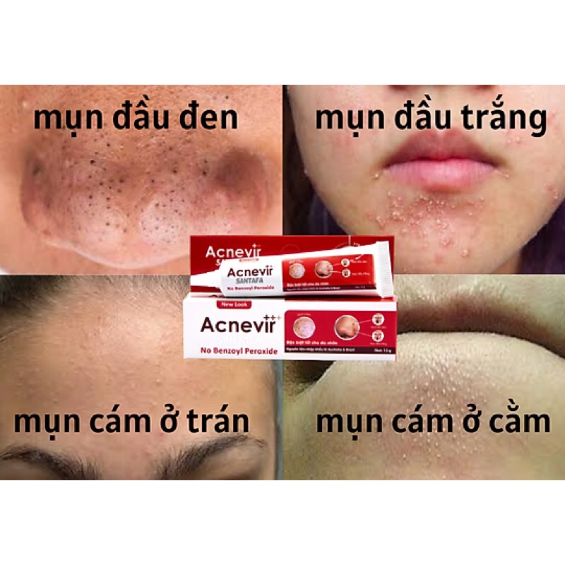 Kem giảm mụn đầu đen, đầu trắng, mụn cám Acnevir 3 In One- Tuýp 15gr