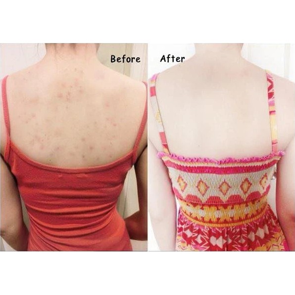 Xà phòng dành cho da mụn OHO Acne Body Clear Soap Thái Lan